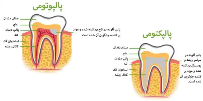 تفاوت پالپکتومی و پالپوتومی دندان